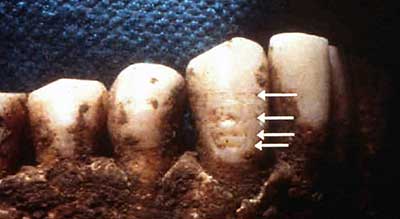 William Hudson's bottom teeth. Arrows point to nutritional stress lines.